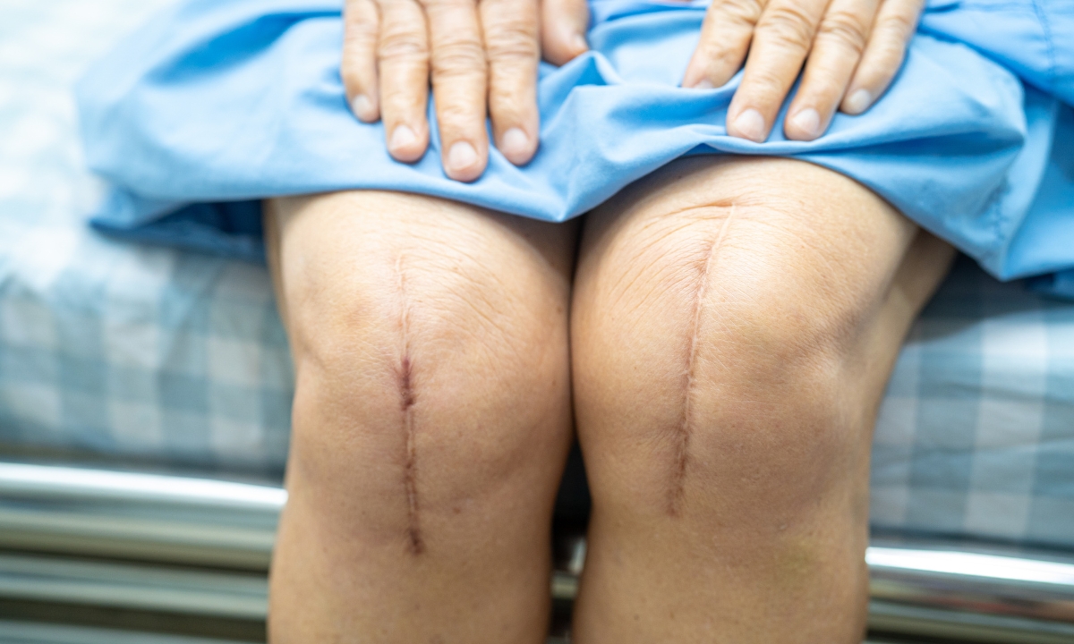 a person's knees poking out from a hospital gown, the knees have large surgical scars